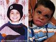 Youssif of Iraq - Youssifs burns