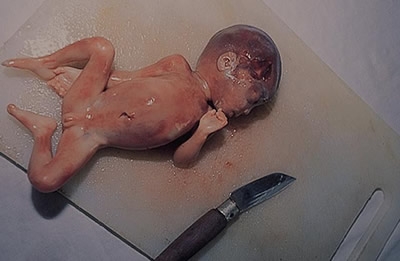 aborted baby - Take a look on this picture...