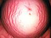 stretch marks - Stretch marks will fade
