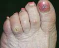 corns - Corns at the fingers of feet. corns - Corns at the fingers of feet.