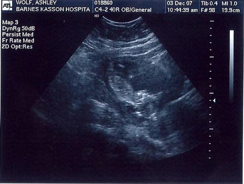 Our 2nd Baby - First ultrasound- 14 weeks.