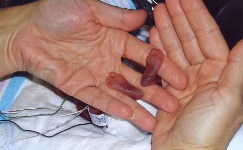 Amazing baby birth - Its a reall picture of a world tiny baby at newyork hospital