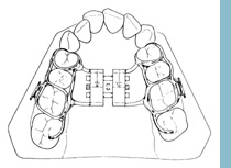 Palate Expander - View of palate with expander in place