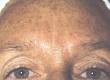 Hyperpigmentation - The ill effects of global warming.