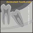 wisdom teeth - wisdom teeth positioned differently