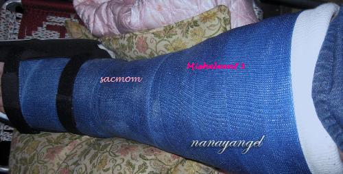 signing your cast.. hope you get lots of signature - signing your cast.. hope you get lots of signatures