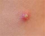 Zit - Pop it!! Ewww!! LOL