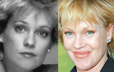 trout pout LOL - melanie Griffith before and after pic