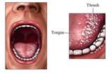 This is Thrush of the mouth - It's very painful but not abnormal. It's not widely known so I thought I'd pass this on.