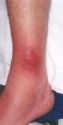 cellulitis - his image displays a red, swollen,tender leg typical of cellulitis, a bacterial skin and soft tissue infection