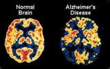 This is Alzheimers - Interesting isn't it? Sad but interesting.