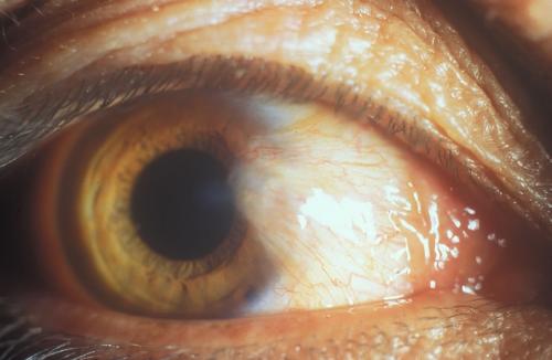 Pterygium - it shows the eye with pterygium. 