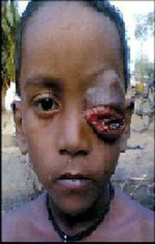 this is the guy whos eyes are completely damage - this boy is sunil who lost his eyes in an accident .and that minor accident finaly become a cancer due to lack of treatment as per his parents they are unable to treat he is very very poor . 