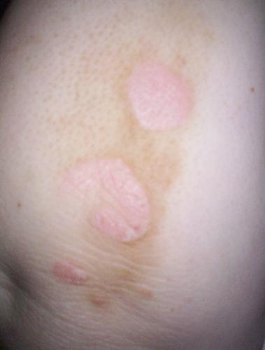 Psoriasis on my elbow - It's so big and noticeable and the look on people's faces when they see it is really off-putting. They act like you've got some terrible disease that might be contagious. Having psoriasis is really the pitts.