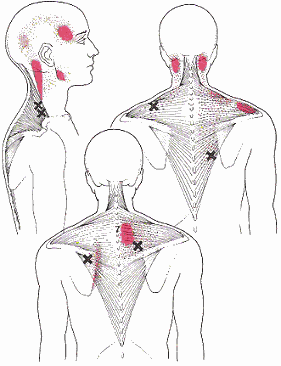 Painful points - Neck and shoulders pains