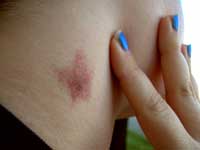 HIckey - neck hickey