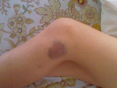 How can anyone hit a child like this?? - This is my son's leg after my sister in law 'taught him a lesson'.
