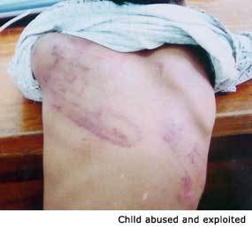 child abuse - bruises all over the child's body