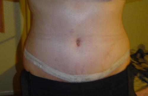 tummy tuck - after abdominoplasty (tummy tuck), muscle adjustment, and liposuction