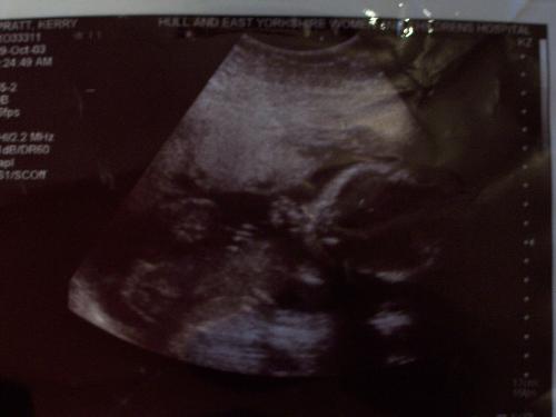 20 weeks - Our eldest daughter at 20 weeks pregnant!!