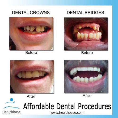 Affordable dental care options - No dental insurance? Check out http://www.healthbase.com for affordable dental options.
