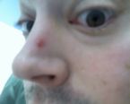 Would you tell her? - pimple face Would you tell her? - pimple face