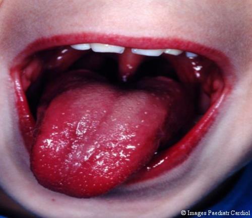 Kawasaki Disease - This is one of the effects of the disease