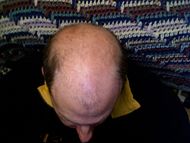 bold - hair loss... any good prescription?