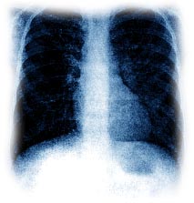 Lungs - X-ray Lungs that are affected with cs.