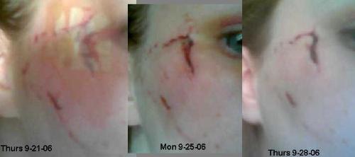 when I first got bitten - my scar looks much better now, but I still wish I didn't have it :(