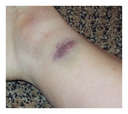 Picture of a bruise - This is a picture of a bruise but not my bruise. I got this of Google!