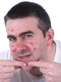 zits - oh the popping pleasure!