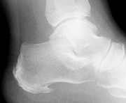 heel spur - heel spur x-ray