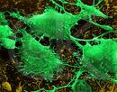 cancer - top cancer causing foods
