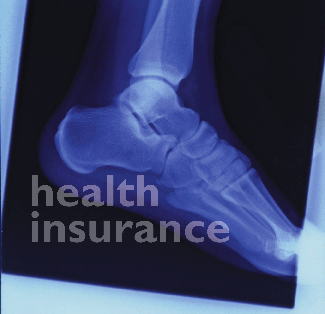 Health Insurance - X-ray photo of a foot.