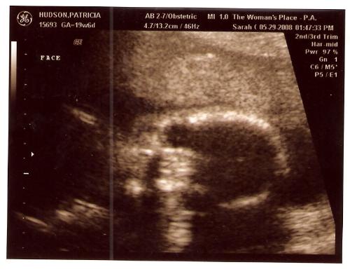 Sonogram Picture of our Baby Boy - He is looking straight at you in this pic...he looks a little alienated.
