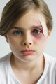 kid with blackeye - a kid with a blackeye and swollen eyes kid with blackeye - a kid with a blackeye and swollen eyes