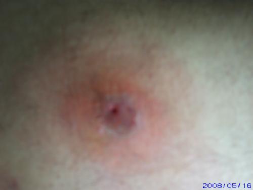 MRSA Bump on my leg - Just one of the pictures I took of the last bump I got. MRSA Bump on my leg - Just one of the pictures I took of the last bump I got.