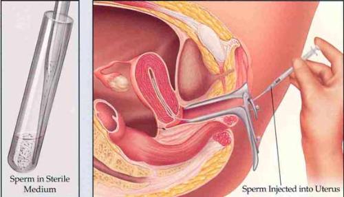 Artificial Insemination - A picture of artificial insemination procedure. The injection contains sperm injected to a woman's uterus.
