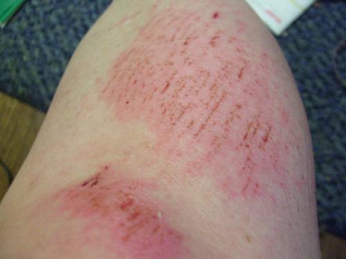 This is what my leg looks like. - I was walking with hubby, but did not pay attention to the curb. OUCH!