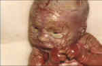 HarleQuin - This is the disease where there's no skin in this baby. It because of genetic mutation. What a poor baby.