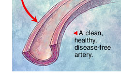 artery - arterial plaque artery - arterial plaque