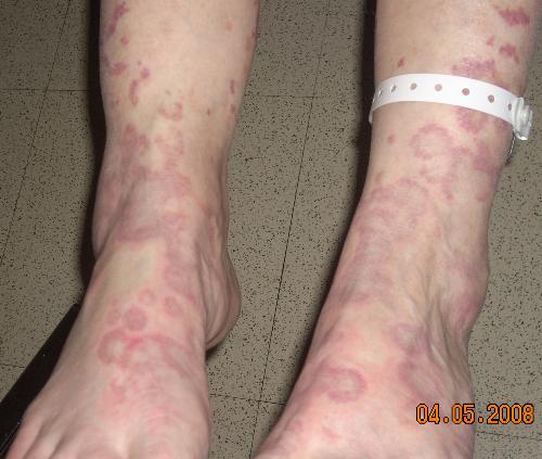 Vasculitis - this is a picture of the rash that my mom had that they said was caused by vasculitis, her feet were in this picture the fresh part her legs were beginning to clear up only after 2 days.