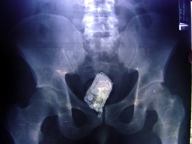 Cell Phone In The Anus - X Ray Photo of a Cell Phone In The Anus of A Peeping Tom