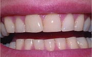 bruxism - this is what grinding can do to your teeth.