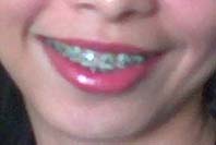 braces - i miss the time when i still have my braces...