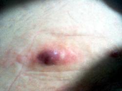 A typical Stage 1 Hs sore - this is a typical stage 1 Hidradenitis sore.