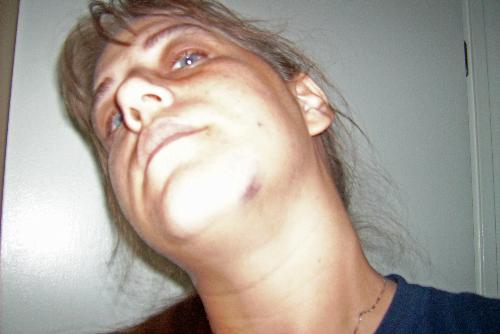 This is the bruise I recieved from Kat - This is not all of the damage done, but this is one of the things Kat did to me last night.