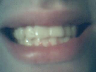 Teeth - My teeth, quite an old picture though! Like.. years old, lol=P Was too lazy to take a recent picture..