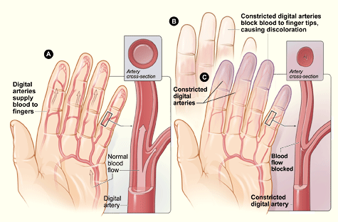 raynaud disease - Raynaud's disease is a rare disorder of the blood vessels, usually in the fingers and toes. People with this disorder have attacks that cause the blood vessels to narrow. When this happens, blood can't get to the surface of the skin and the affected areas turn white and blue. When the blood flow returns, the skin turns red and throbs or tingles. In severe cases, loss of blood flow can cause sores or tissue death. Cold weather and stress can trigger attacks. Often the cause of Raynaud's is not known. People in colder climates are more likely to develop Raynaud's than people in warmer areas.  Treatment for Raynaud's may include drugs to keep the blood vessels open. There are also simple things you can do yourself, such as   * Soaking hands in warm water at the first sign of an attack  * Keeping your hands and feet warm in cold weather